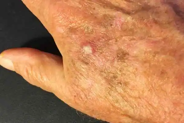 Image of Actinic keratoses Bridgend on a person hand