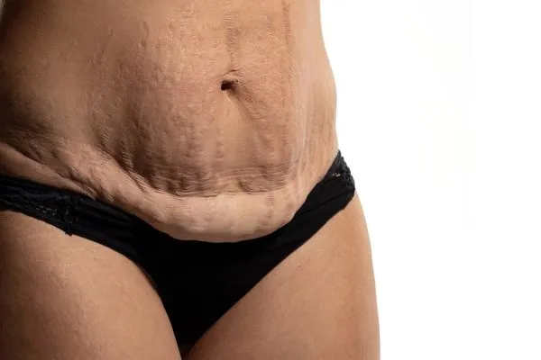 The science behind skin tightening Bridgend picture of a woman's sagging skin on the stomach